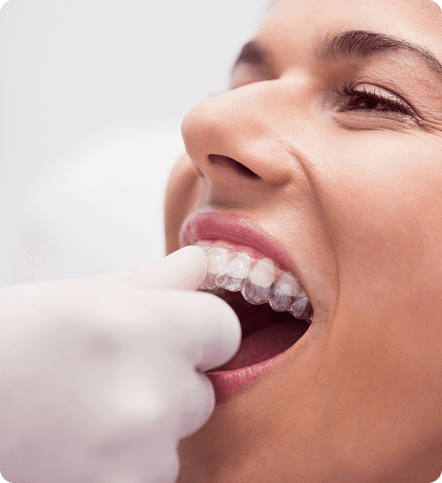 Patient wearing clear aligners